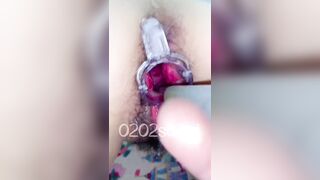 lấy ống tiêm bơm thăgr tinh trùng vào tử cung em phần 2