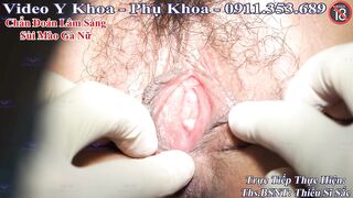 Khám sùi mào gà